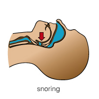 airway-snoring